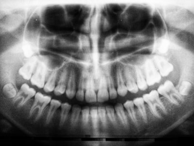 Atención Multi-Cabeza como Estimación Nadaraya-Watson: Varianza, Descorrelación y Diversidad Óptima
