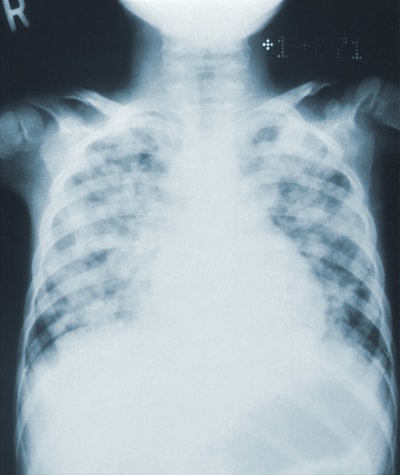 Jerarquía Clínica de Radiología Multiagente para Informes de TC